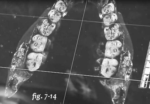 7-14 jaw computer image